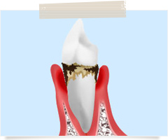 歯周病を治療してお口と身体の健康を守りましょう