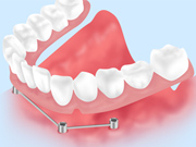 インプラントオーバーデンチャー（自費の入れ歯）