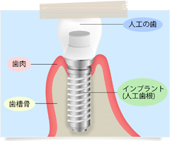 インプラント治療