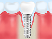 Pick Up! インプラント周囲炎とは