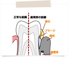 歯周病の原因は何？