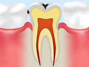 C1～エナメル質のむし歯～ 