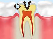 C2～象牙質に達したむし歯～