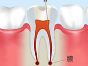 1.むし歯部分の除去